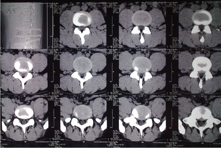 ③腰椎磁共振(腰椎mri).