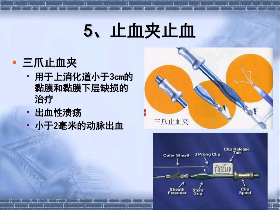 内镜下消化道止血术