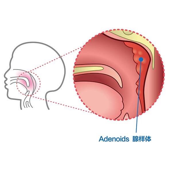腺样体的收割高峰已至，割还是不割？  腺样体手术详解