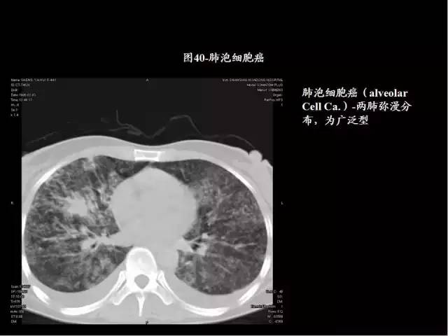为什么做胸、腹部CT扫描时需要吸气-屏气-吐气？