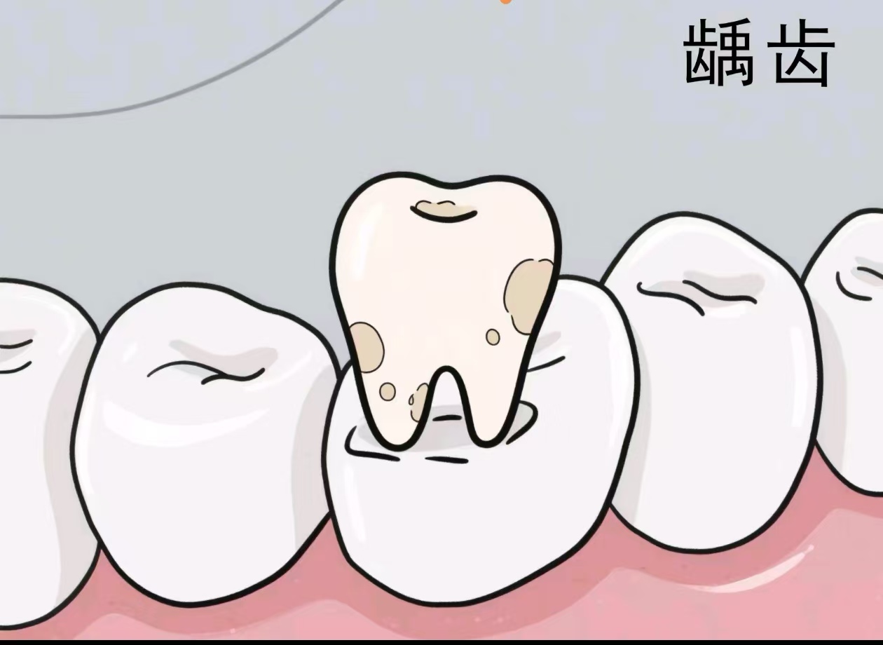 关于干燥综合征龋齿的那些事儿
