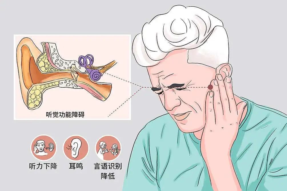 突袭的寂静——突发性耳聋，72小时内必须就医的耳科急症