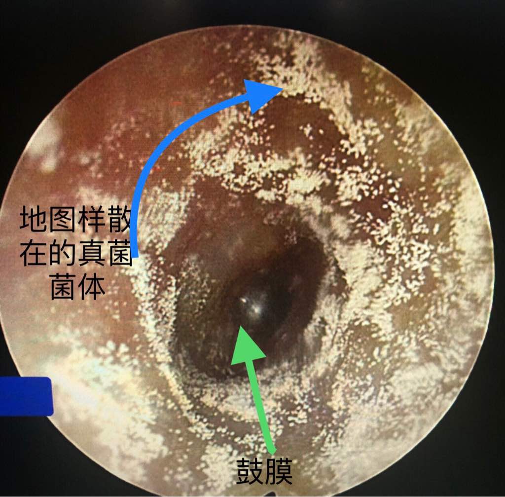 耳朵里长“蘑菇”？当心真菌性外耳道炎！别乱掏，这样做才正确！