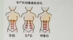 女性产后大肚腩一都是腹直肌分离惹的祸