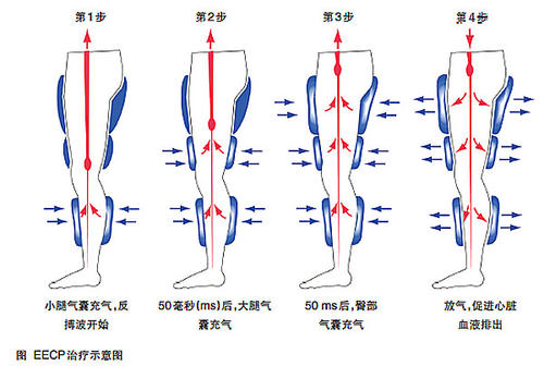 体外反搏疗法图片